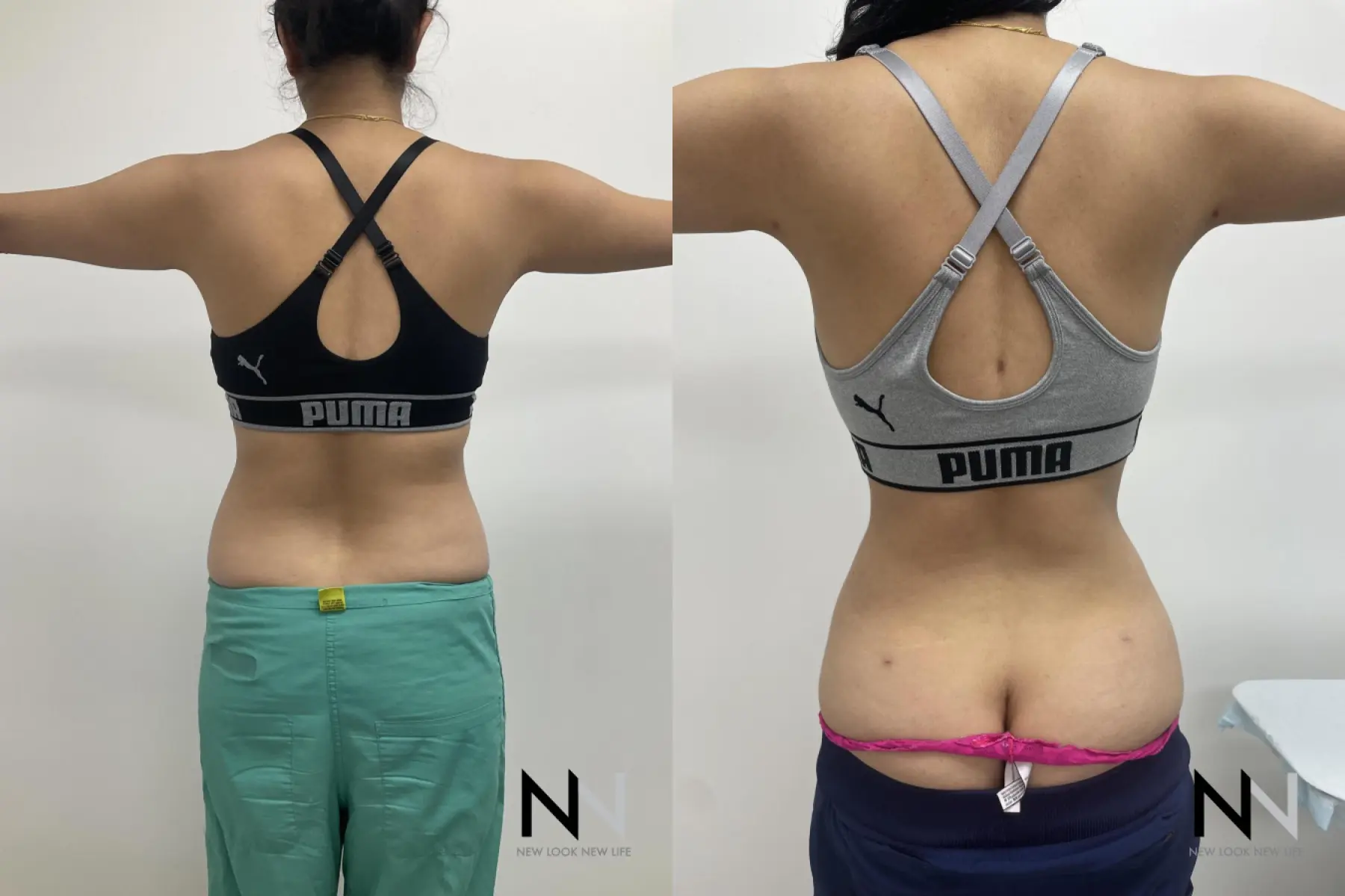 Liposuction: Patient 14 - Before and After 3