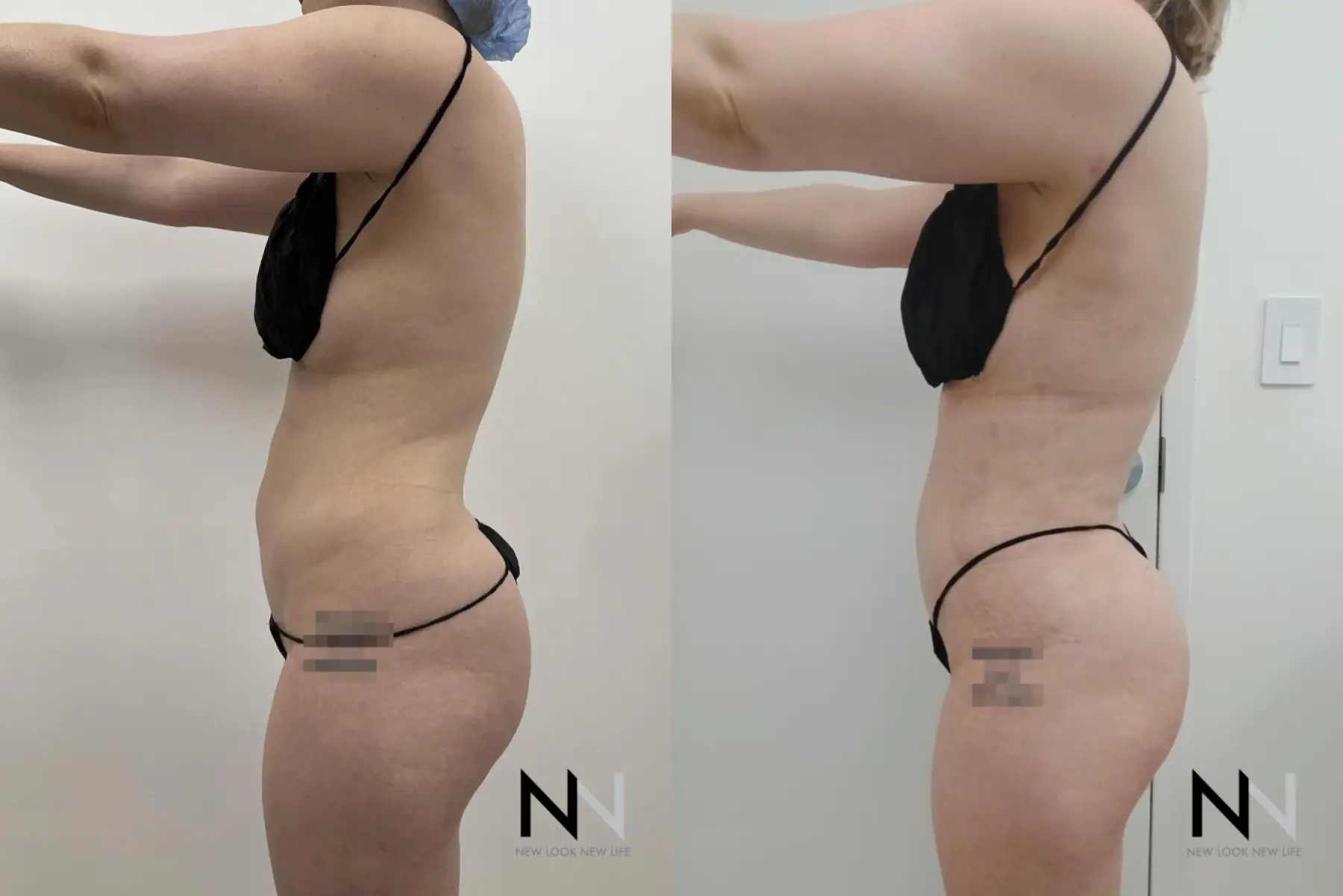 Liposuction: Patient 15 - Before and After 2