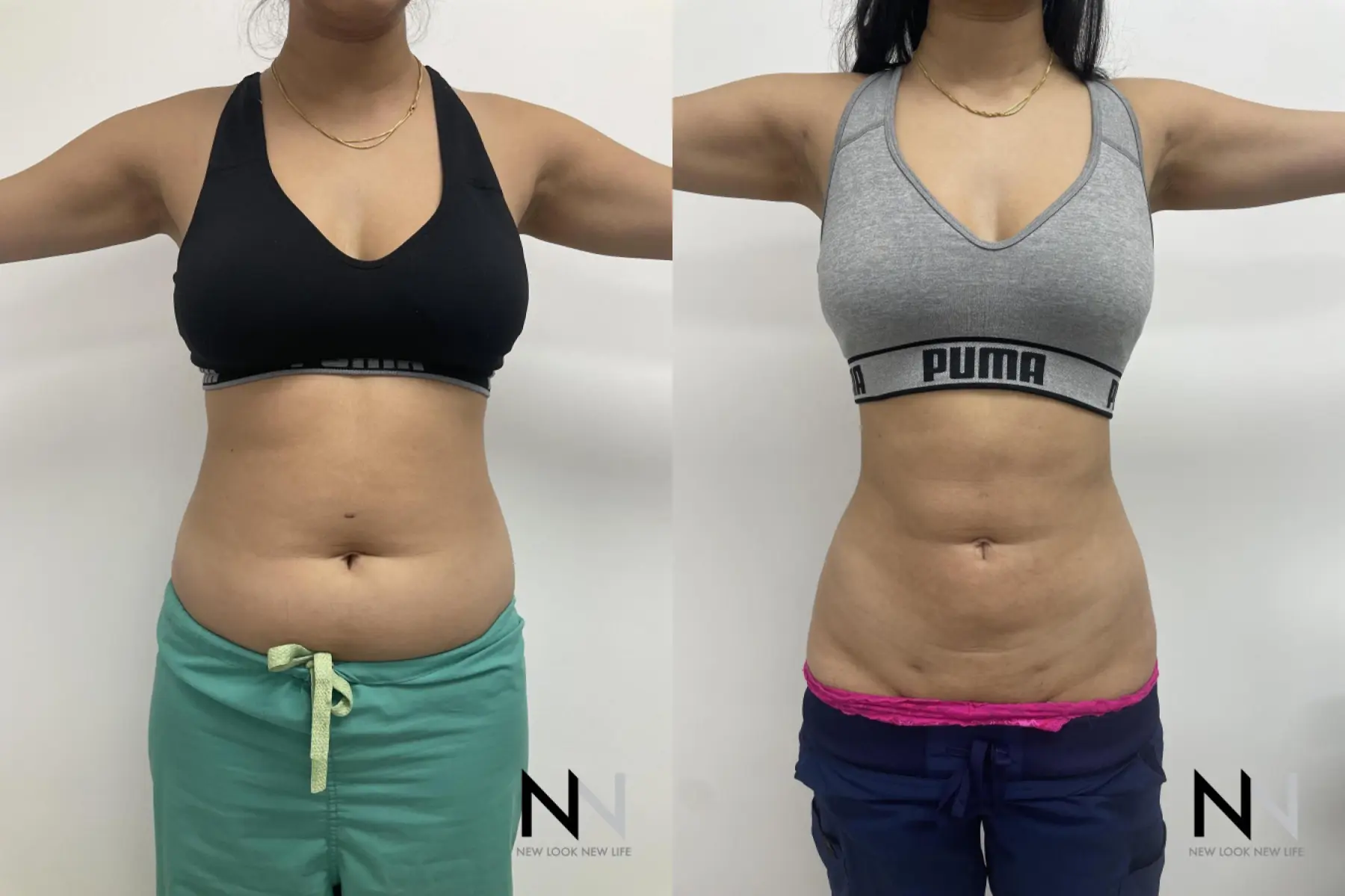 Liposuction: Patient 14 - Before and After 5