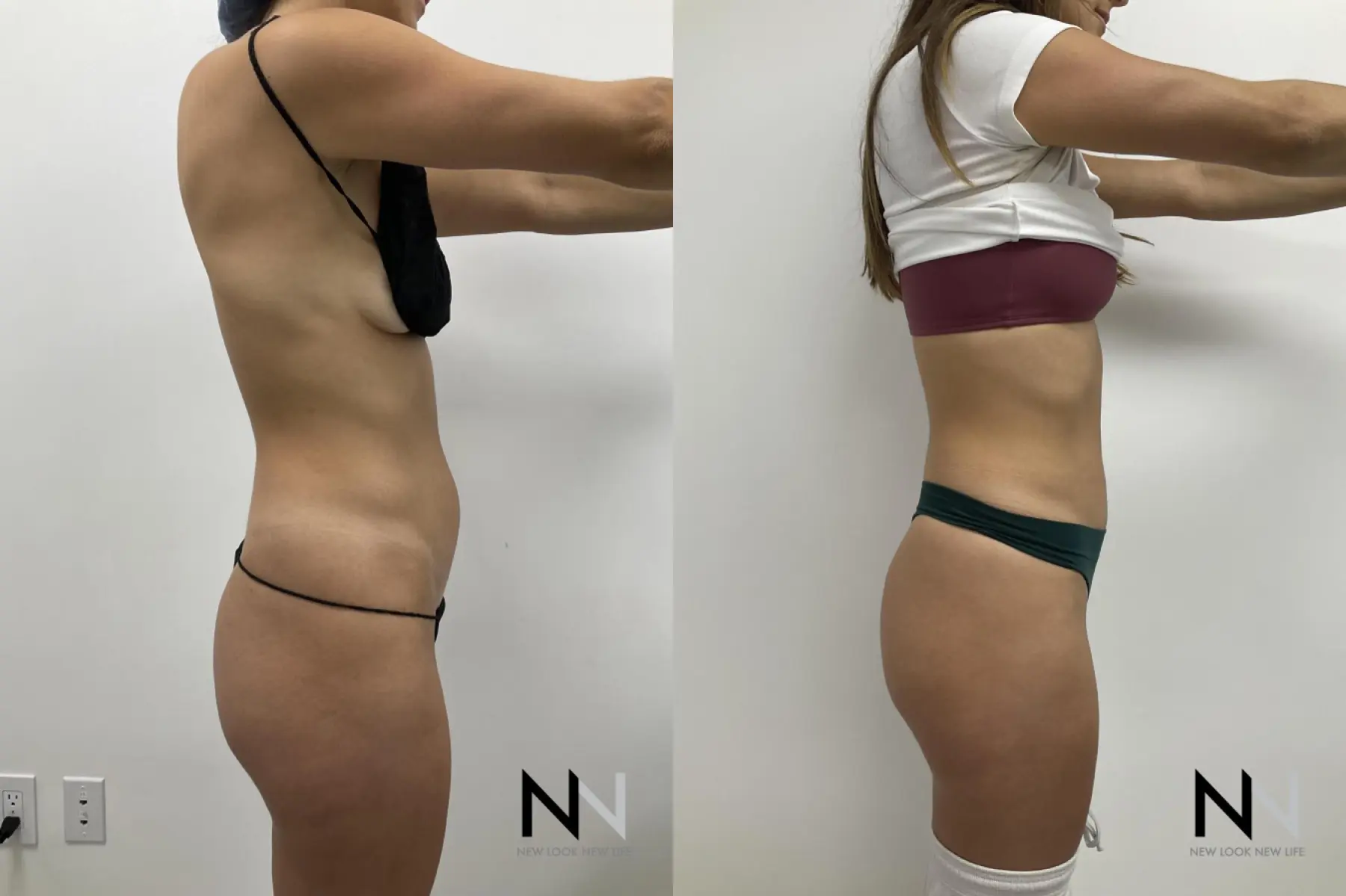 Liposuction: Patient 3 - Before and After 2