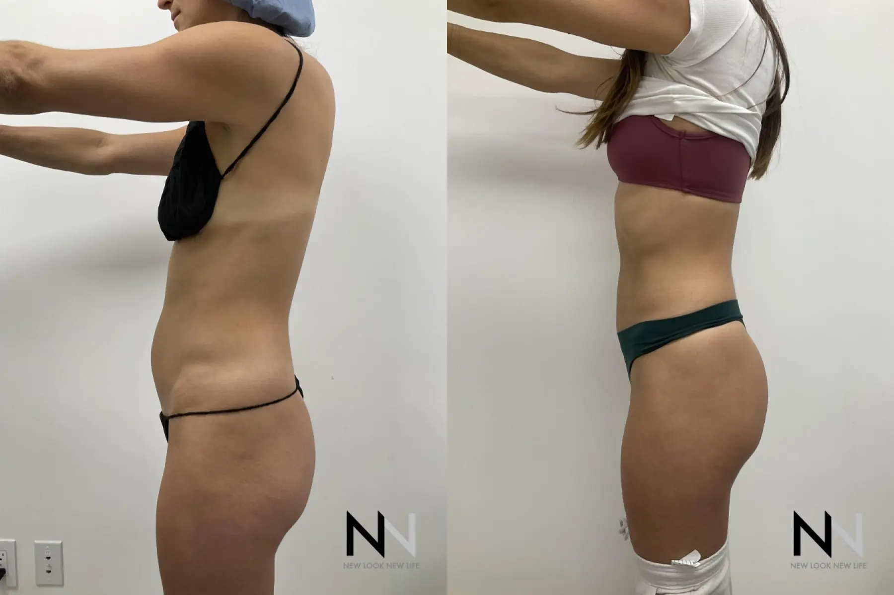 Liposuction: Patient 3 - Before and After 3