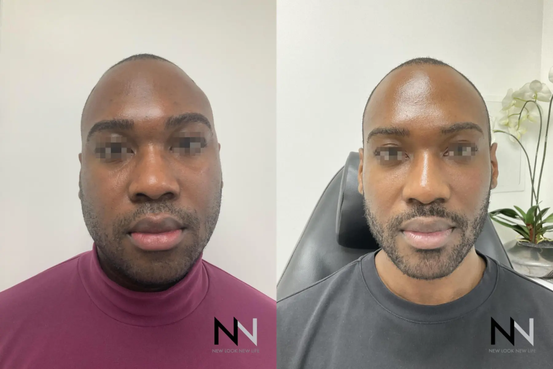 Liquid Facelift: Patient 5 - Before and After  