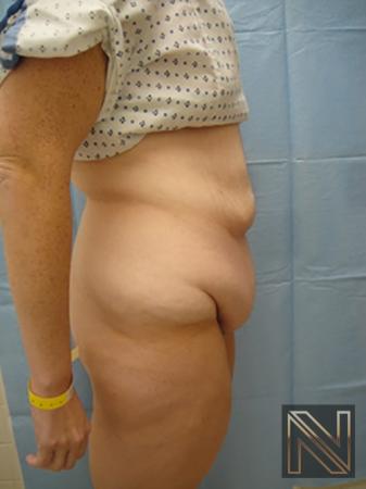 Abdominoplasty: Patient 2 - Before and After 3