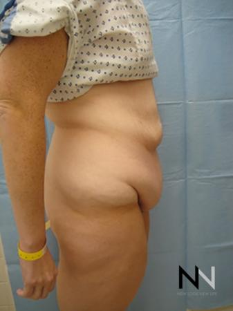 Abdominoplasty: Patient 2 - Before and After Image 3