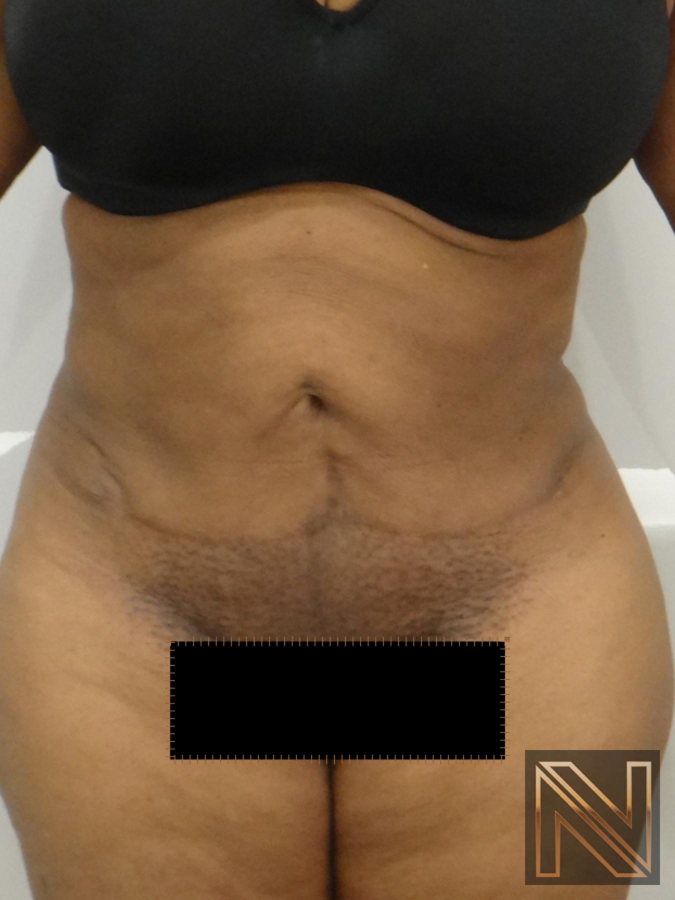 Mini Tummy Tuck: Patient 1 - After 1
