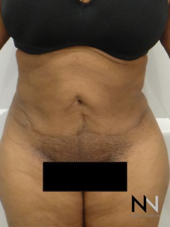 Mini Tummy Tuck: Patient 1 - After Image 1