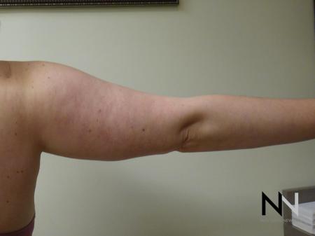 Liposuction: Patient 24 - After Image 4