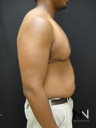 Gynecomastia: Patient 1 - After Image 5