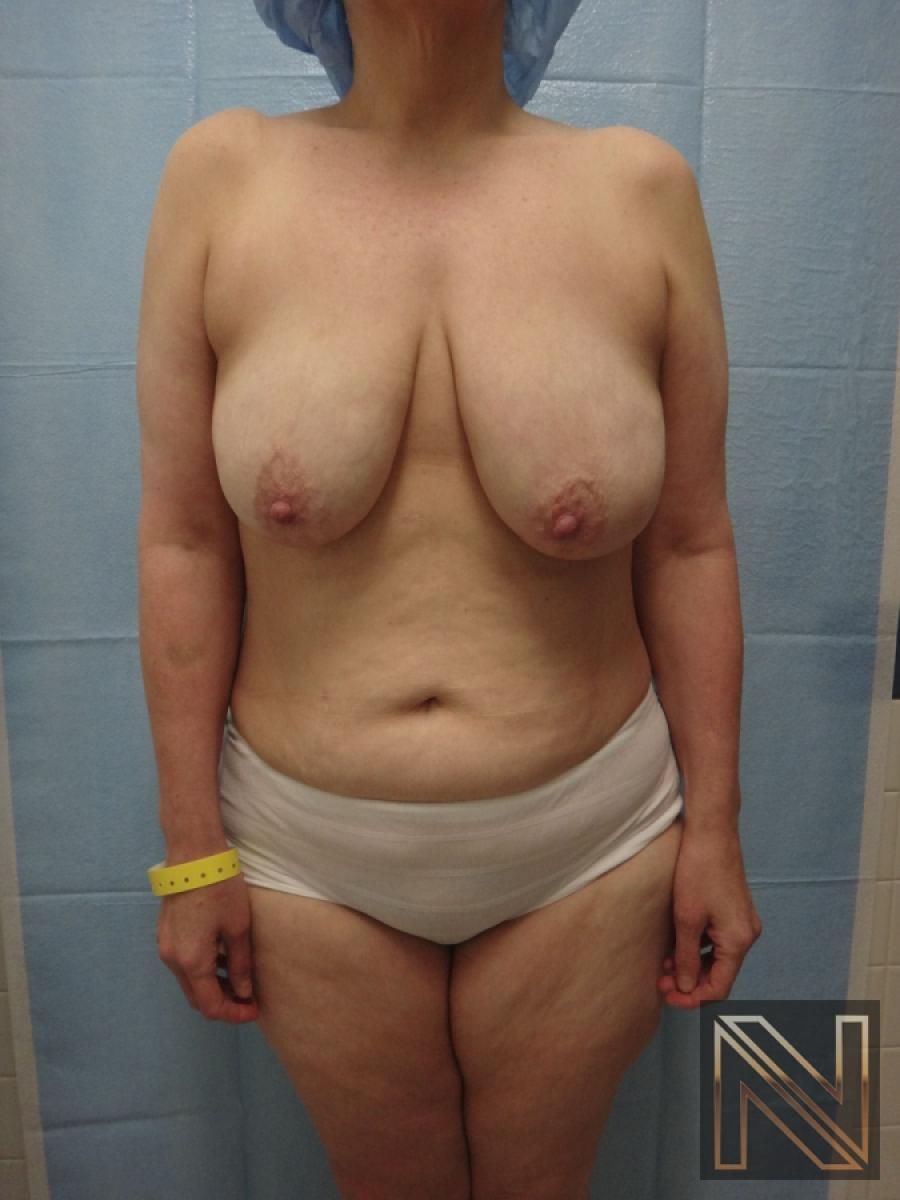 Breast Lift: Patient 3 - Before 1