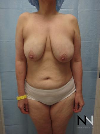 Breast Lift: Patient 3 - Before Image 1