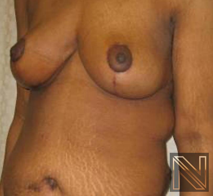 Breast Lift: Patient 13 - After 3