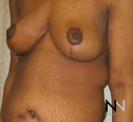 Breast Lift: Patient 13 - After Image 3