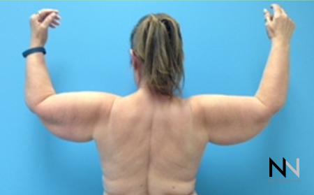 Brachioplasty: Patient 4 - Before and After Image 2