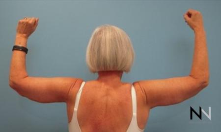 Brachioplasty: Patient 9 - After Image 2