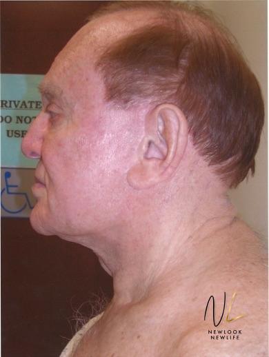 Facelift/Mini Facelift: Patient 9 - Before 1