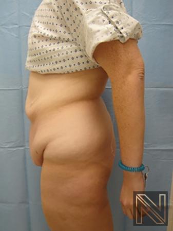 Abdominoplasty: Patient 2 - Before 2
