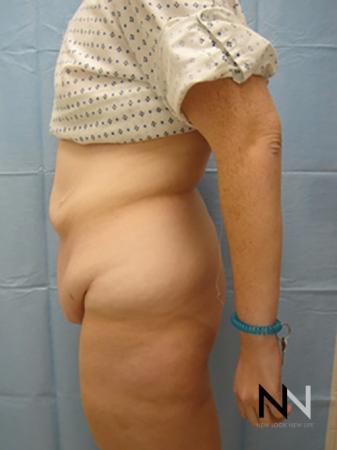 Abdominoplasty: Patient 2 - Before Image 2