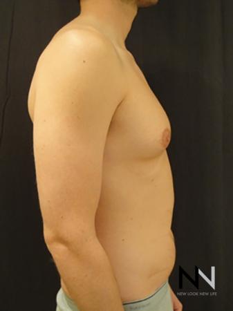 Gynecomastia: Patient 4 - Before and After Image 5
