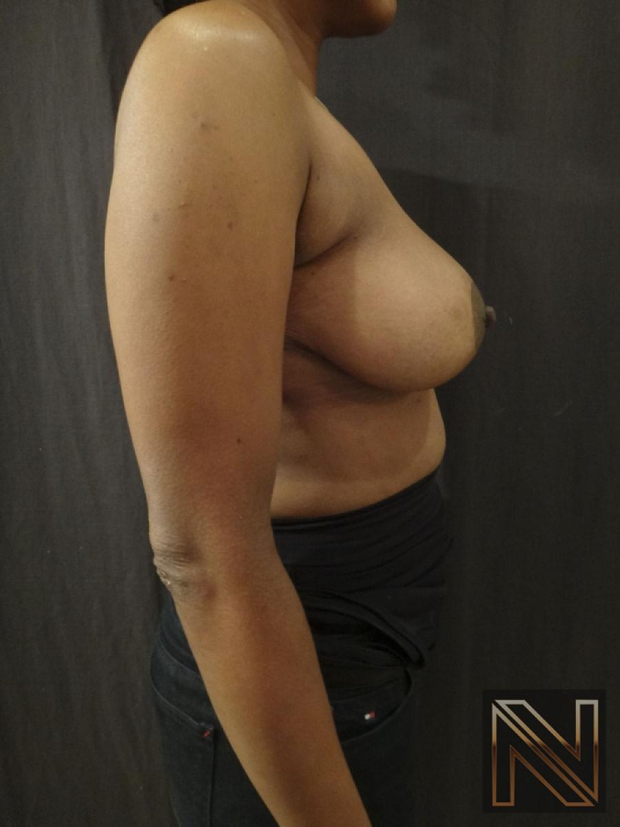 Breast Lift: Patient 2 - After 5