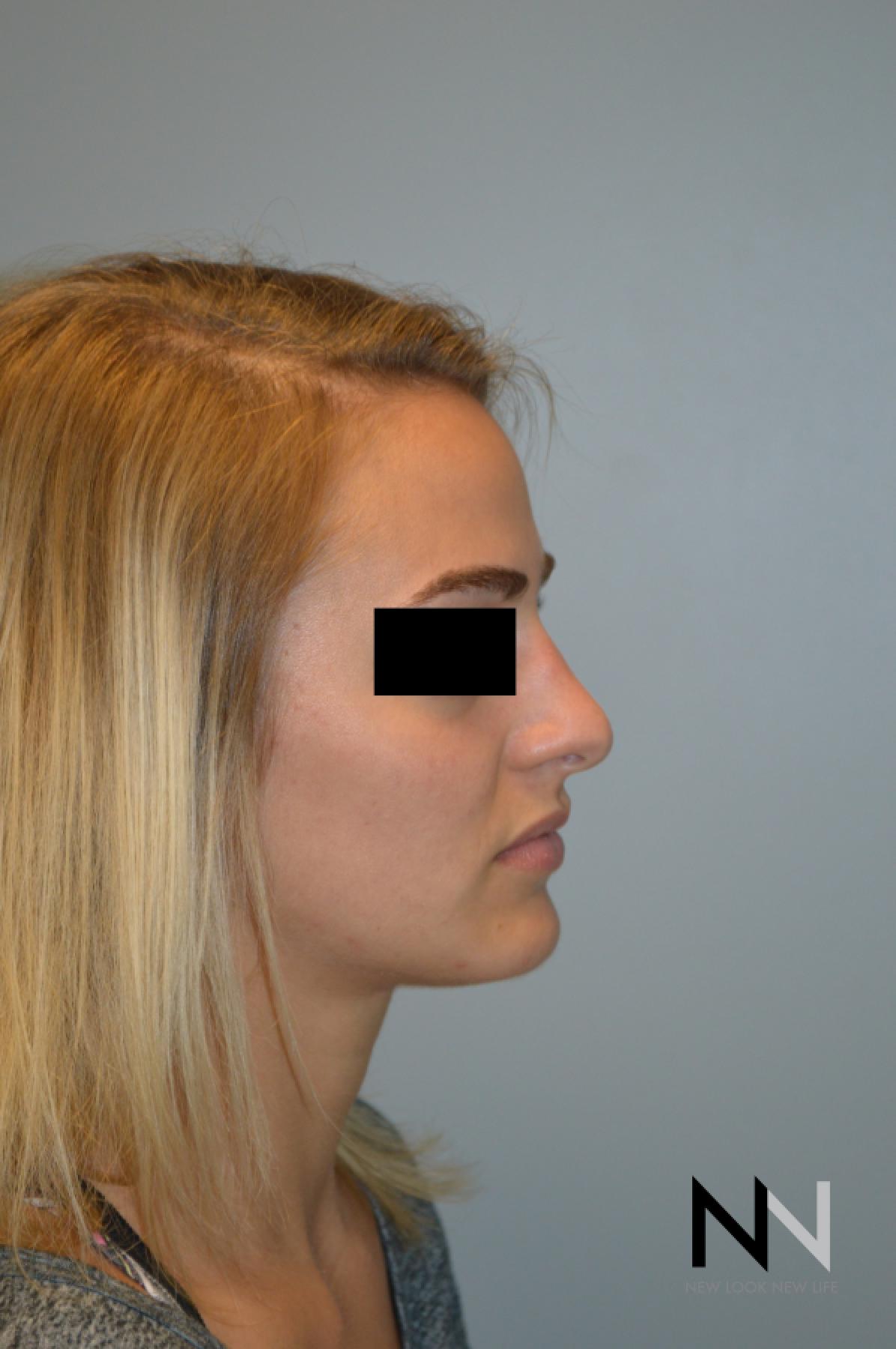 Rhinoplasty: Patient 3 - Before 1