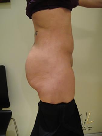 Butt Augmentation: Patient 1 - After Image 2