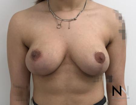 Breast Lift: Patient 17 - After Image 1