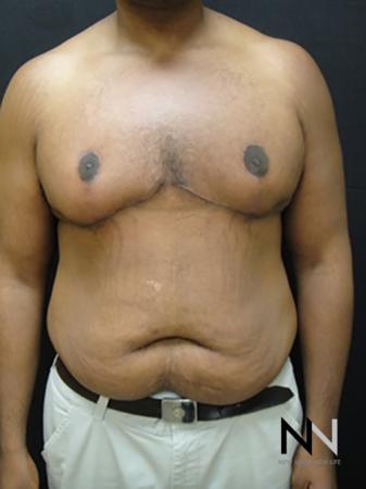 Gynecomastia: Patient 1 - After Image 1
