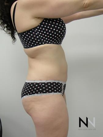 Liposuction: Patient 5 - After Image 3