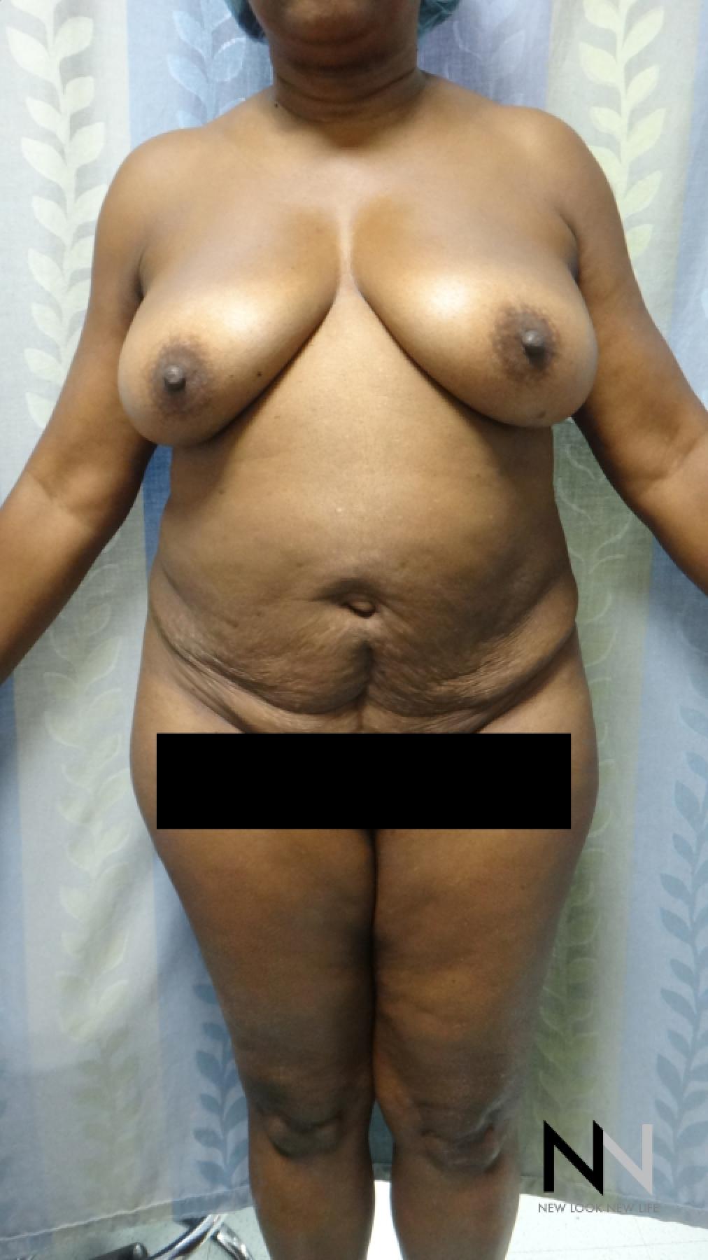 Abdominoplasty: Patient 22 - Before 1