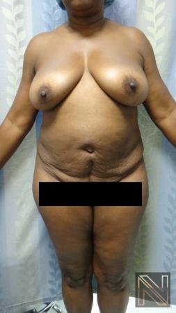 Abdominoplasty: Patient 22 - Before 1