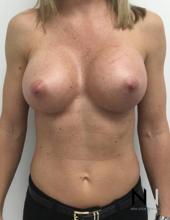 Breast Augmentation: Patient 3 - After Image 1