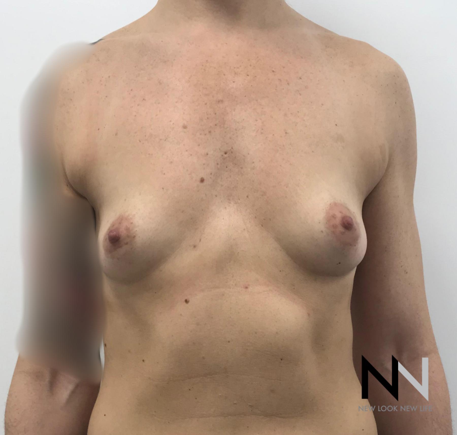 Breast Augmentation: Patient 2 - Before 1