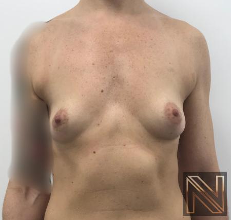 Breast Augmentation: Patient 2 - Before 