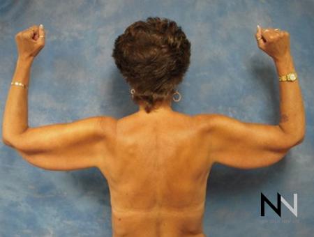 Brachioplasty: Patient 1 - Before Image 1