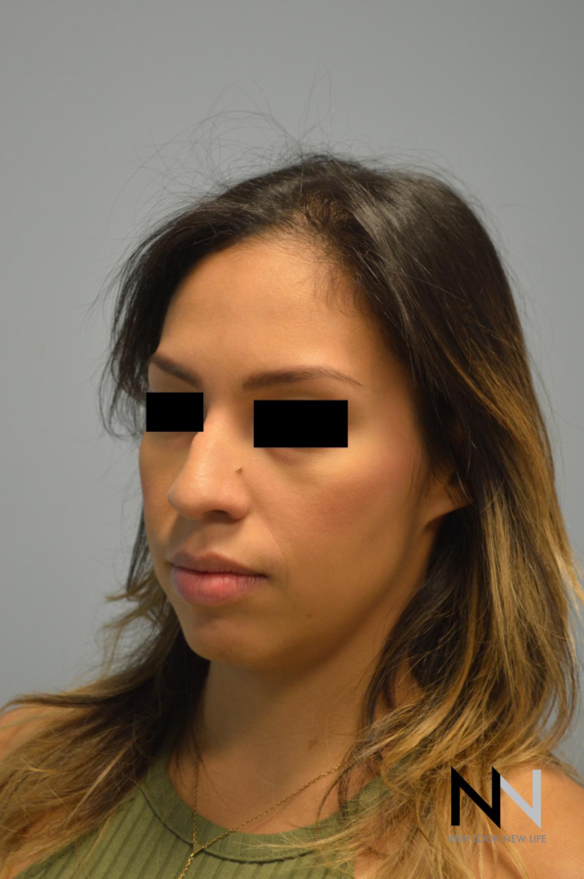 Rhinoplasty: Patient 6 - Before 4