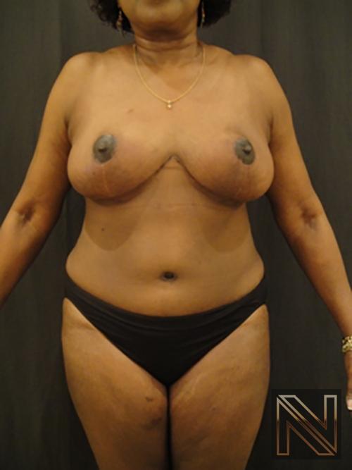 Breast Reduction: Patient 4 - After  
