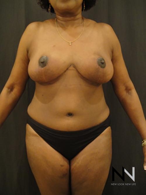 Breast Reduction: Patient 4 - After  