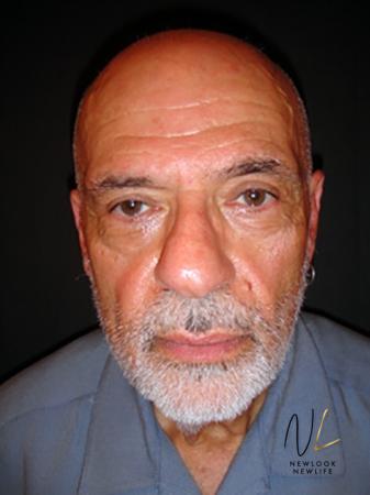 Blepharoplasty: Patient 3 - After Image 1