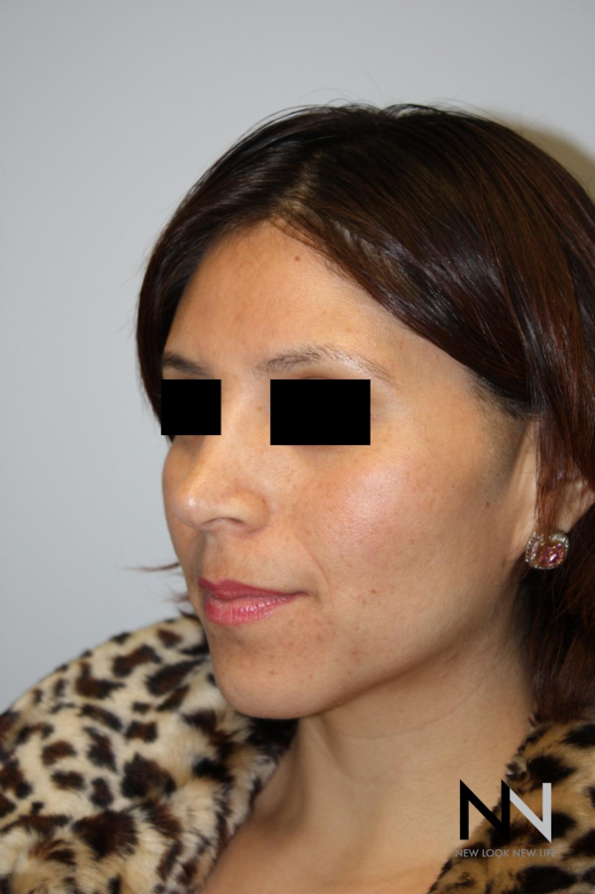 Rhinoplasty: Patient 5 - After 3