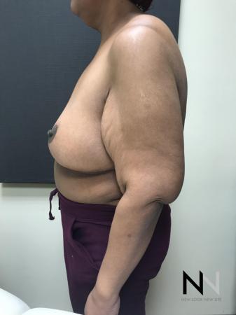 Breast Reduction: Patient 2 - After Image 3