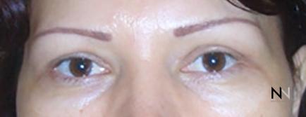Blepharoplasty: Patient 4 - After Image 1