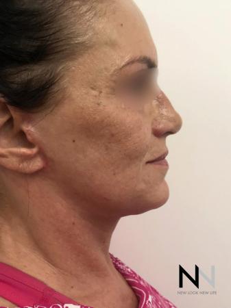 Fractional Resurfacing: Patient 1 - Before Image 2