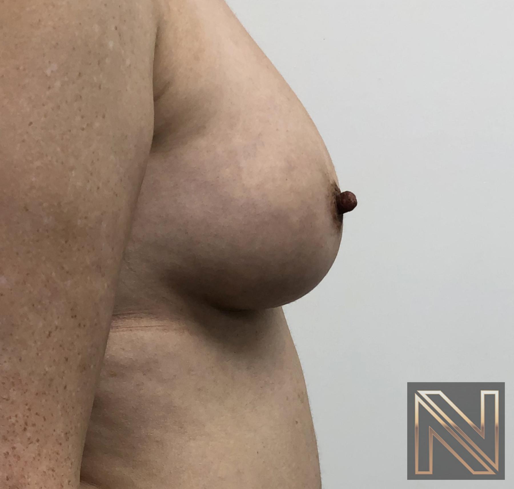Fat Transfer - Body: Patient 2 - After 3