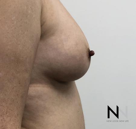 Fat Transfer - Body: Patient 2 - After Image 3