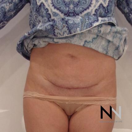 Mini Tummy Tuck: Patient 5 - After Image 1
