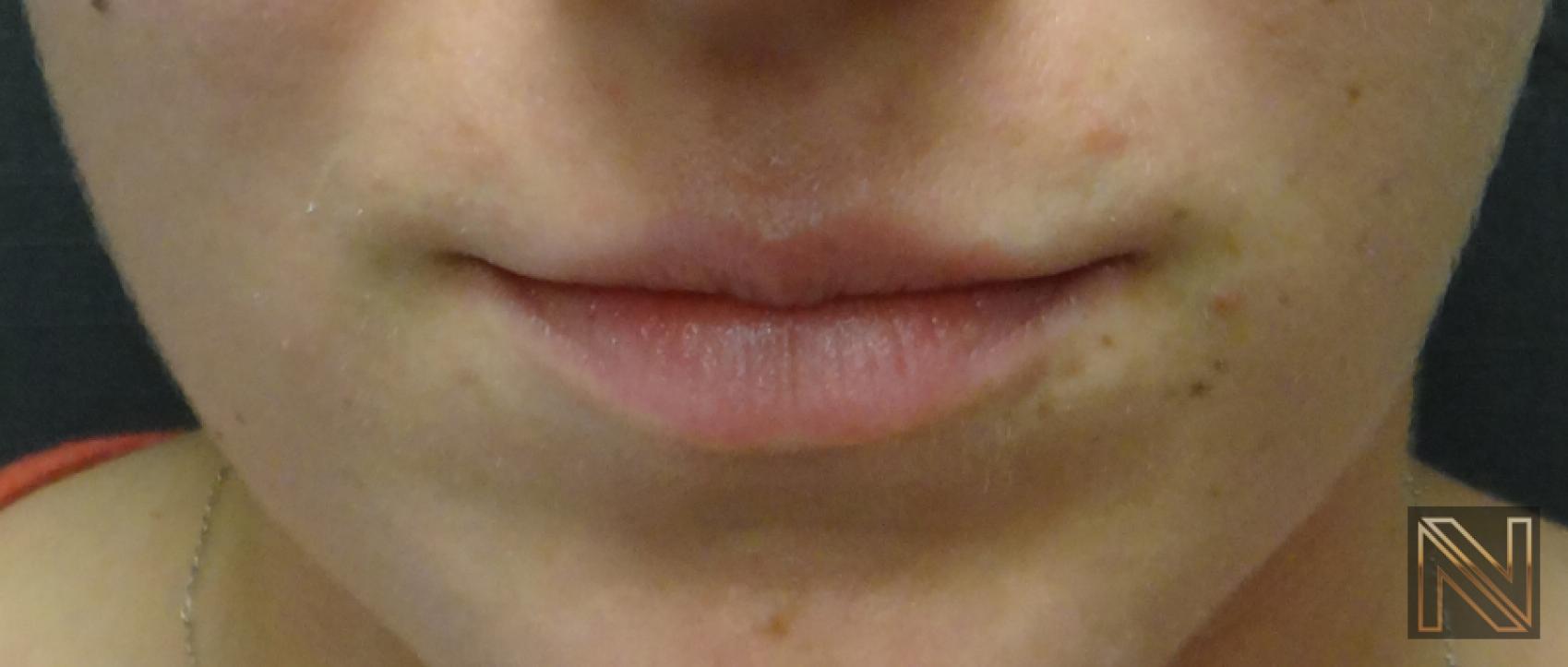 Fillers: Patient 3 - Before 