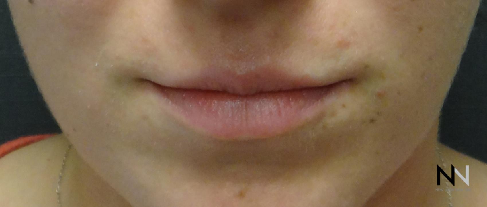 Fillers: Patient 3 - Before 