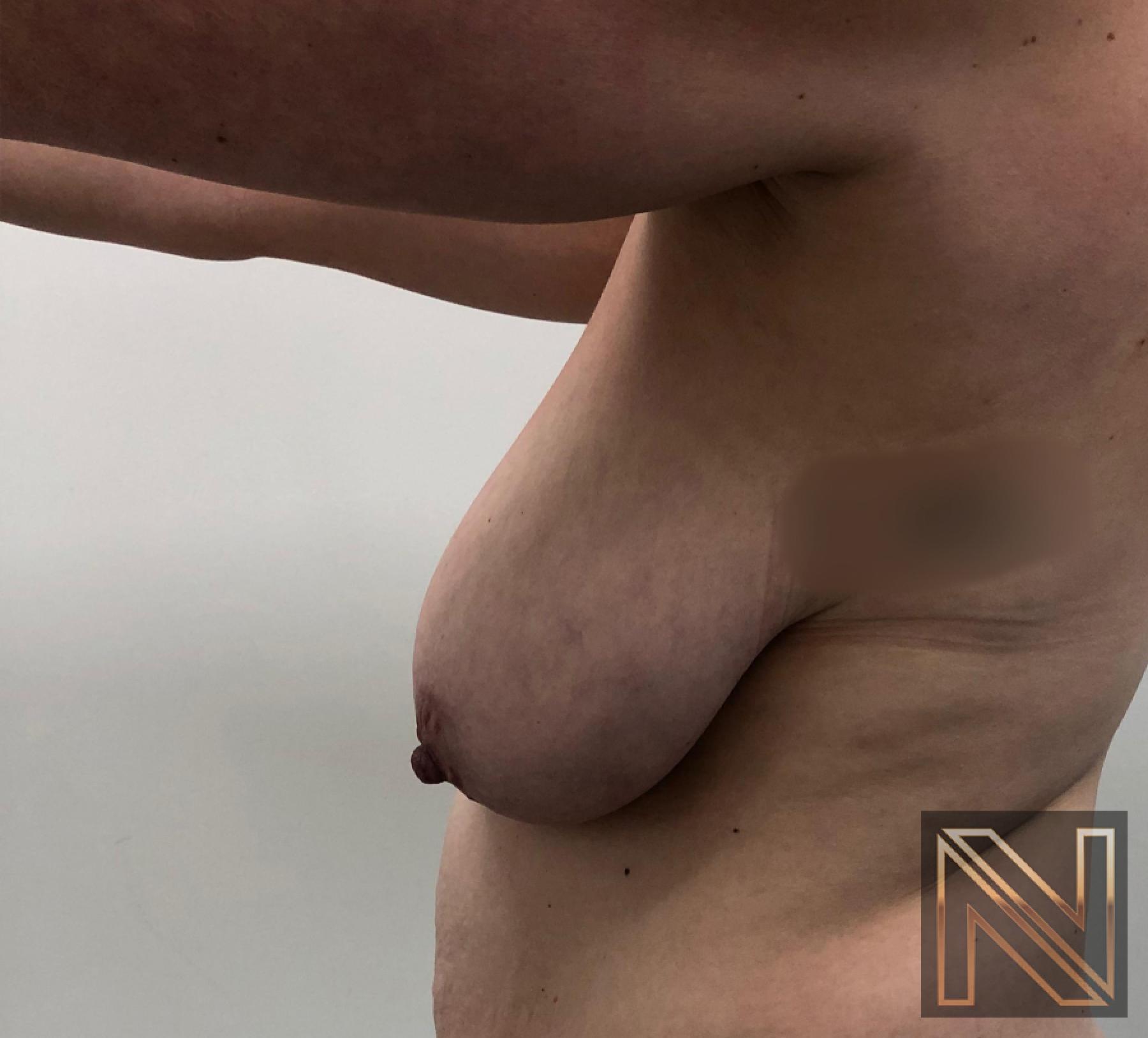 Breast Lift: Patient 16 - Before 2