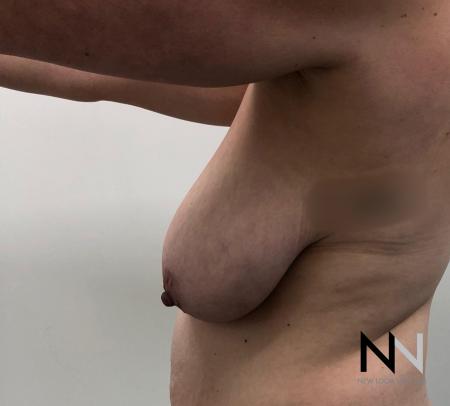Breast Lift: Patient 16 - Before Image 2