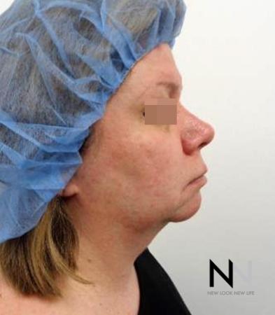 Fractional Resurfacing: Patient 2 - After Image 4